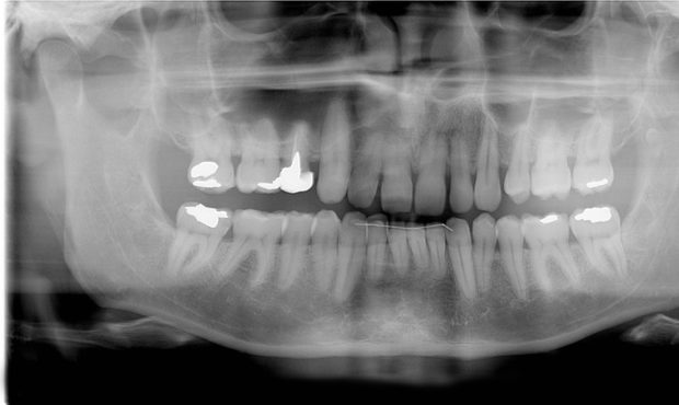 cracked teeth COVID-19...