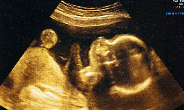 abortion pregnancy ultrasound sonogram...