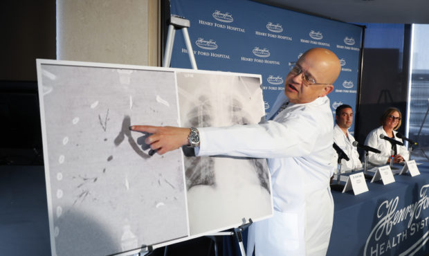 Dr. Hassan Nemeh, Surgical Director of Thoracic Organ Transplant, shows areas of a patient's lungs ...