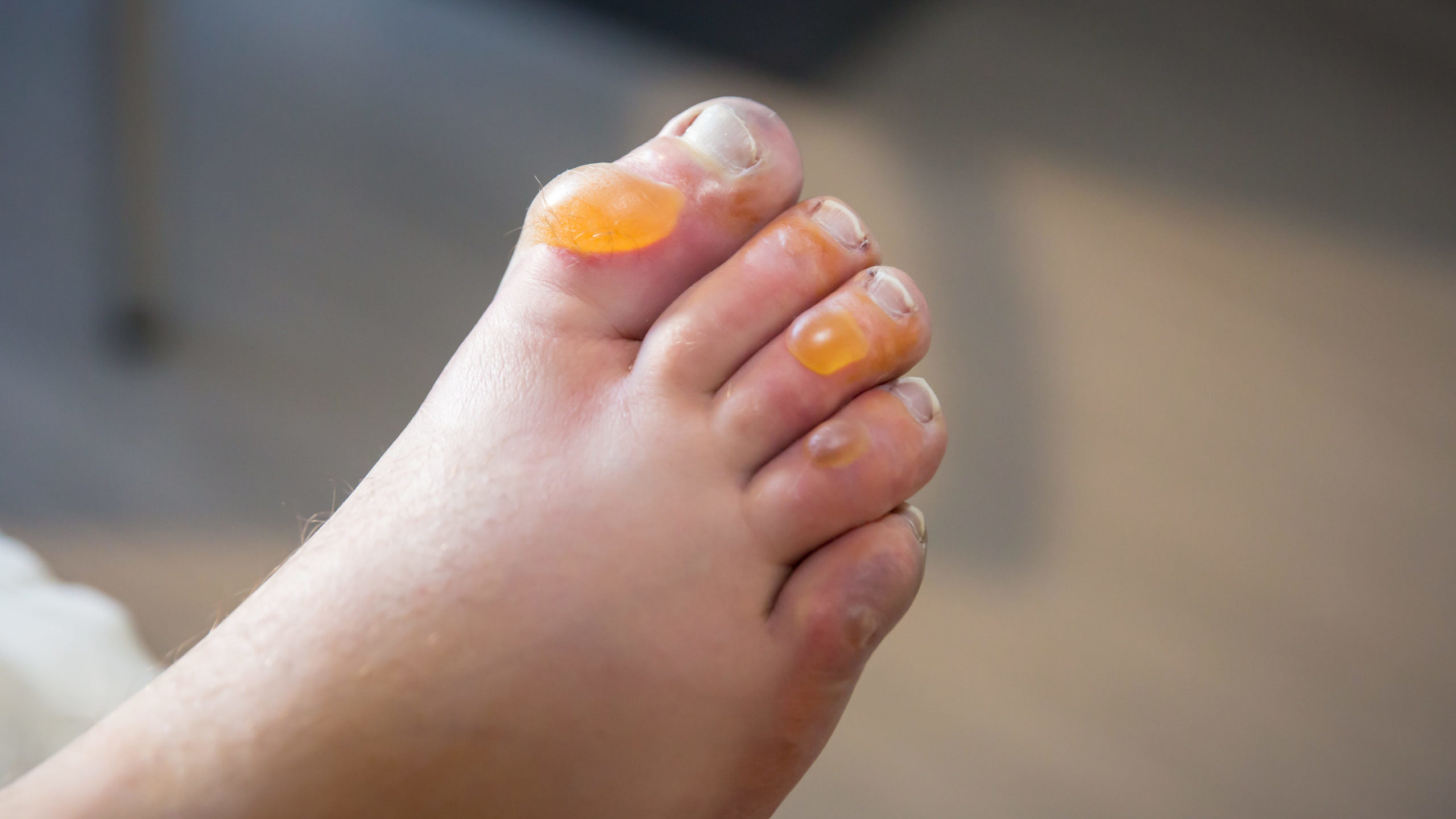 Blisters on the feet of a lost hiker are pictured at the University of Utah Hospital in Salt Lake C...