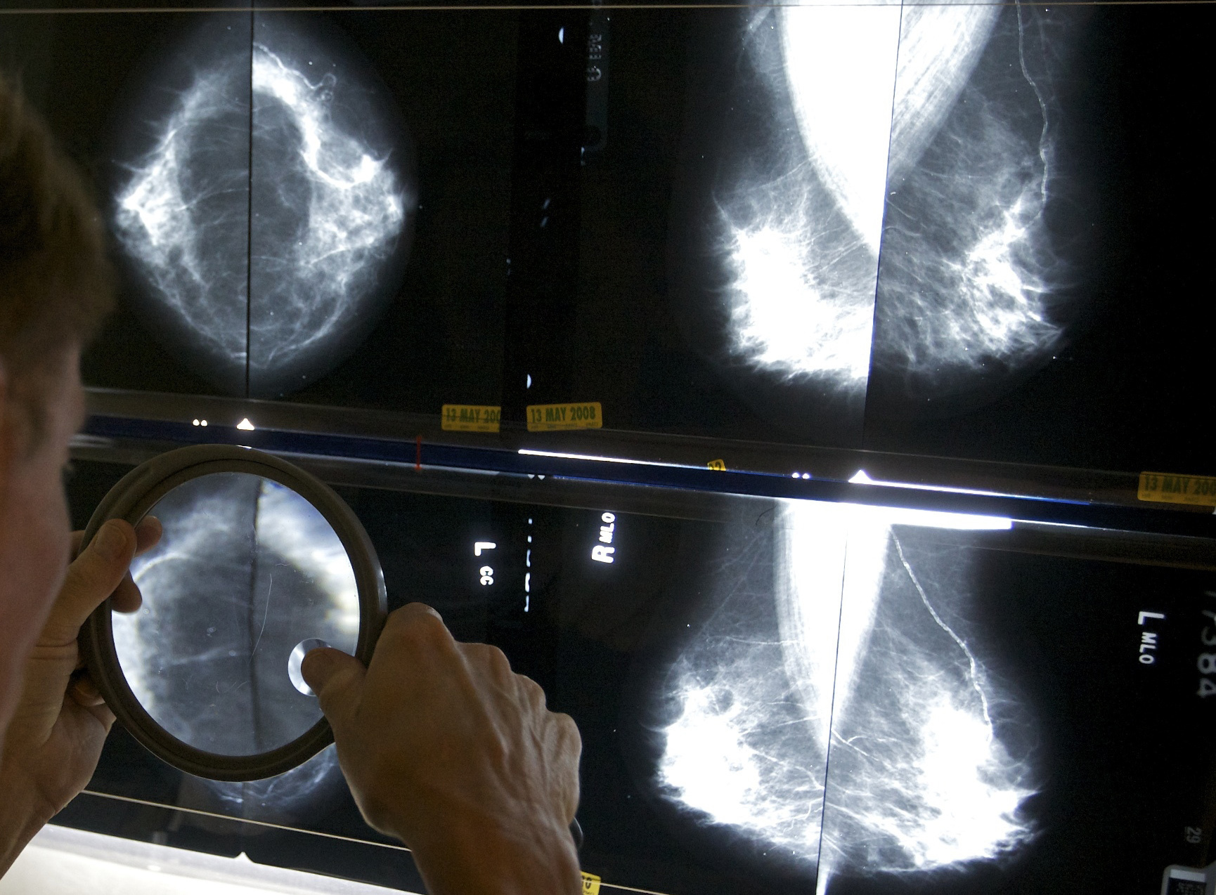 FILE - A radiologist uses a magnifying glass to check mammograms for breast cancer in Los Angeles, ...
