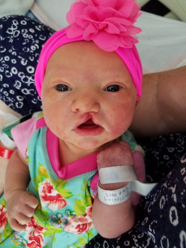 A Utah mother and daughter share their experiences living with cleft lip and palate, from surgeries and treatment to advocacy and support. (Tiffiny Tyler)