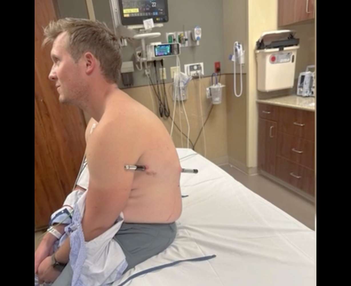 David Cifaldi is pictured after he slipped, causing one of his trekking poles to impale him through his back and out his side. (Photo: KTMF via EastIdahoNews)